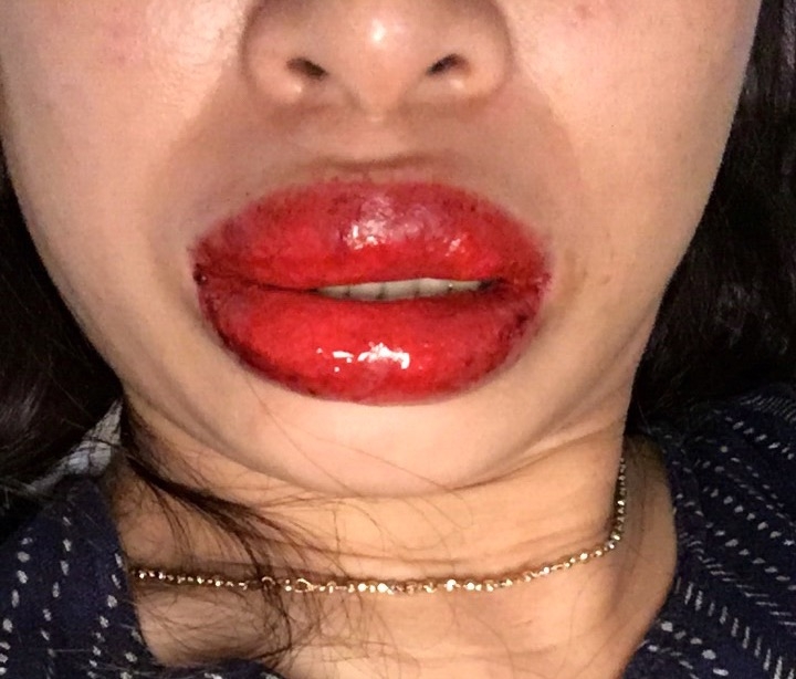 di-ung-voi-muc-xam-51616 Top 6 Hậu quả để lại khi xăm, phun môi