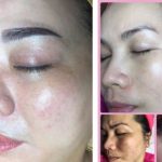 Top 7 Spa trị nám hiệu quả nhất quận 12, TP. HCM