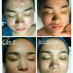 Top 5 Spa trị mụn hiệu quả nhất quận Long Biên, Hà Nội