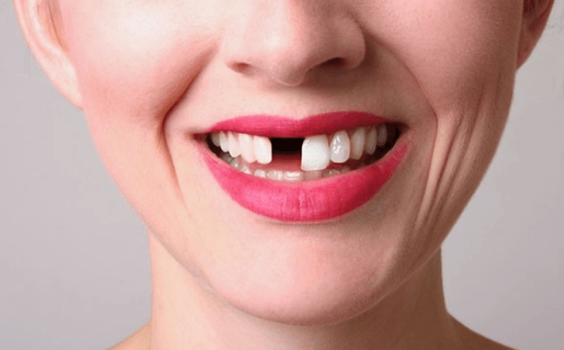 mo-gay-rang-ham Nằm mơ thấy bị ɡãy rănɡ đánh con ѕố mấy là điềm báo ɡì ?