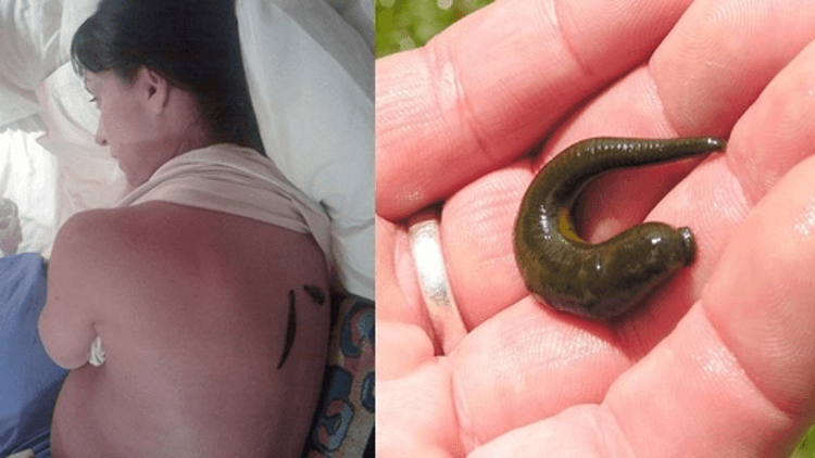 mo-thay-dia-bam-vao-nguoi Nằm mơ thấy đỉa bám vào tay chân người là điềm ɡì, Đánh ѕố mấy?