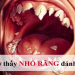 Nằm mơ thấy tự nhổ răng đánh con gì, là điềm báo lành hay dữ